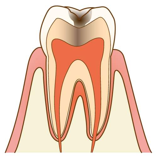 C2：象牙質まで虫歯が到達したときの治療