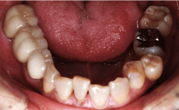下顎の口腔内写真