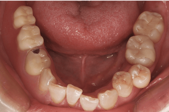 義歯の装着（不良補綴物の再治療）