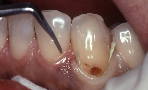 虫歯治療前