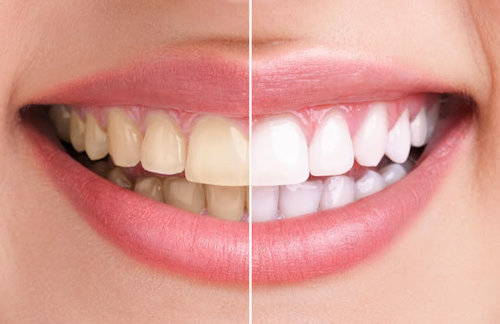 歯を白くして健康的な口元を実現します