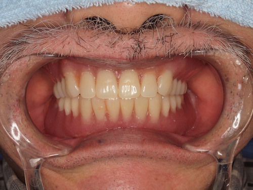 入れ歯を強力に固定するインプラント義歯
