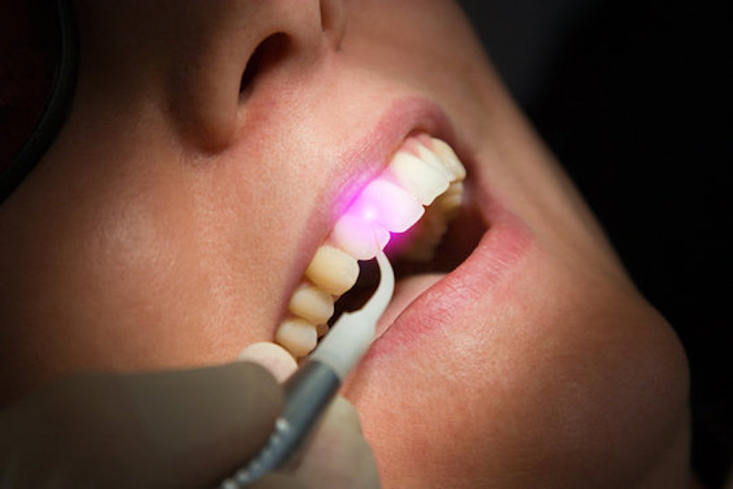 歯周病治療とレーザー治療